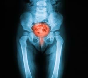 x-ray image of bladder